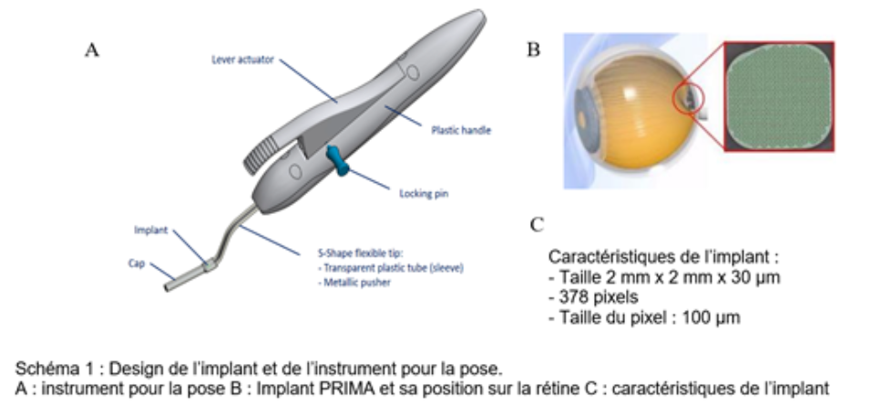 Restaurer la vision par stimulation des cellules rétiniennes